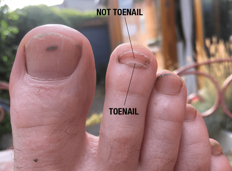 toenail